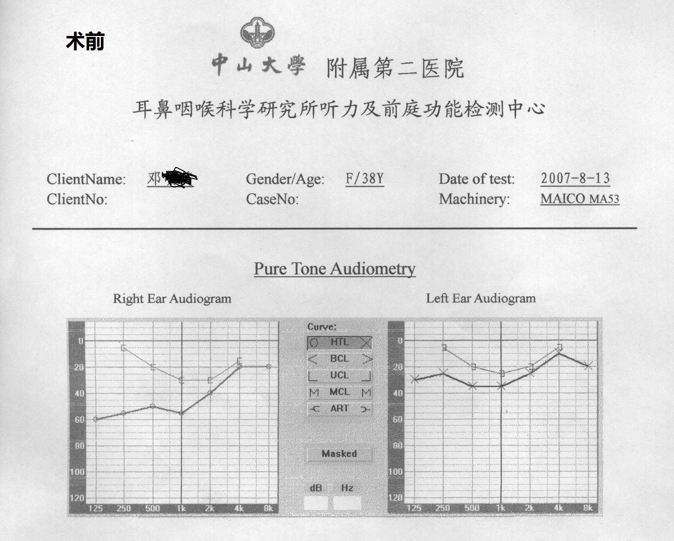 耳硬化症纯音测听图图片