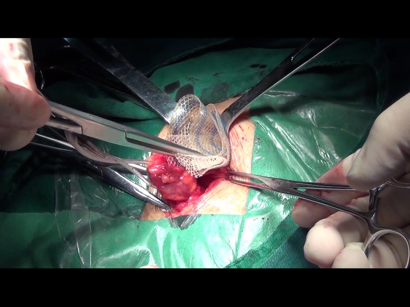 腹股沟疝的手术治疗(uhs) - 好大夫在线