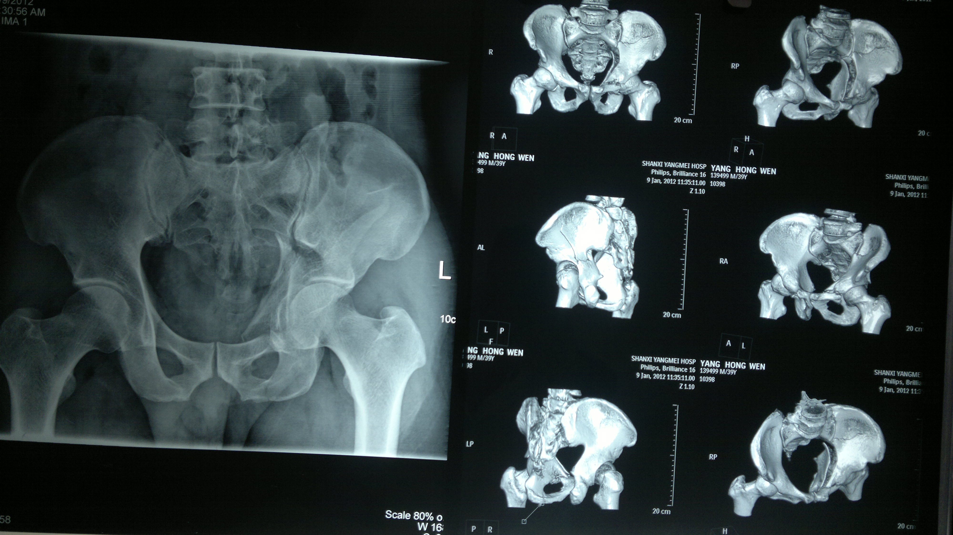 ct三維重建片)(骨盆骨折及股骨頸骨折內固定術後x線片)(骨盆髖臼骨折