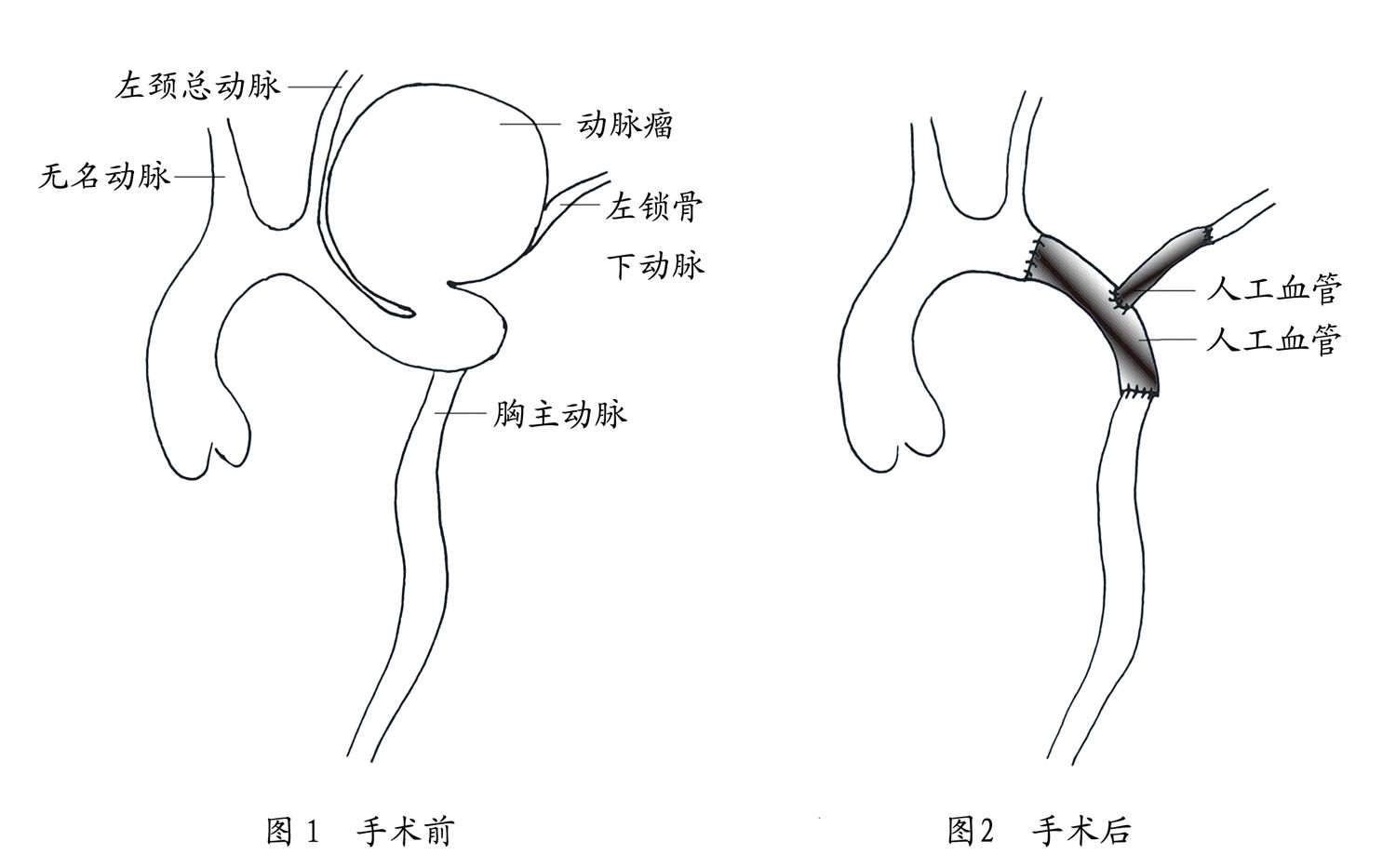 主动脉弓缩窄手术图片