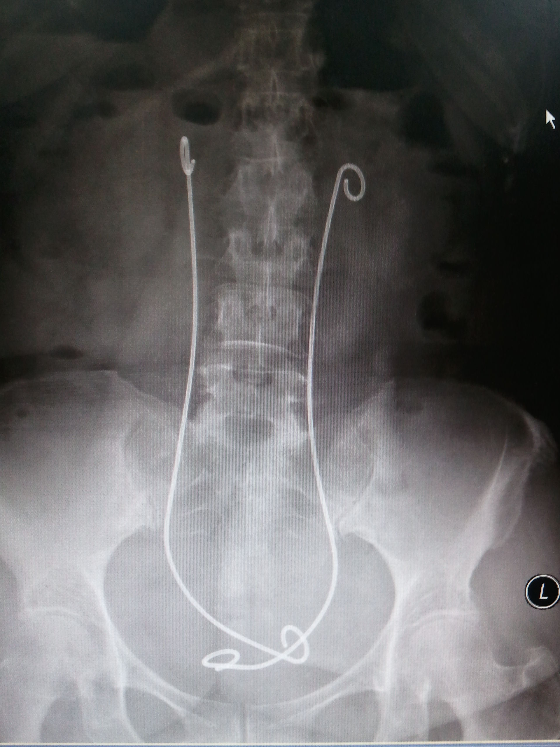 输尿管支架不良反应图片