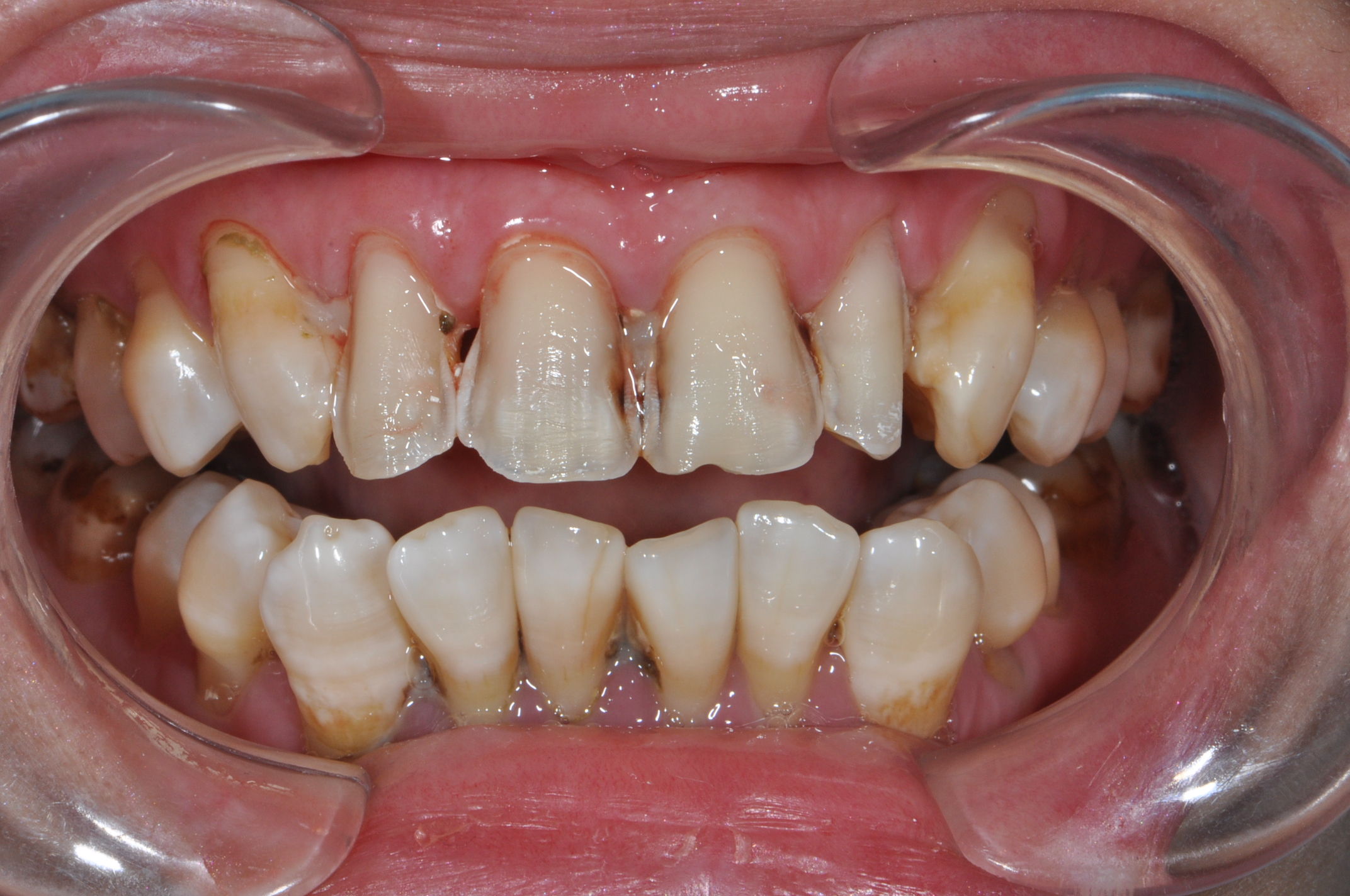 技工中心加工后的瓷贴面图2,牙体预备后:开窗式,保留原有牙齿邻面接触