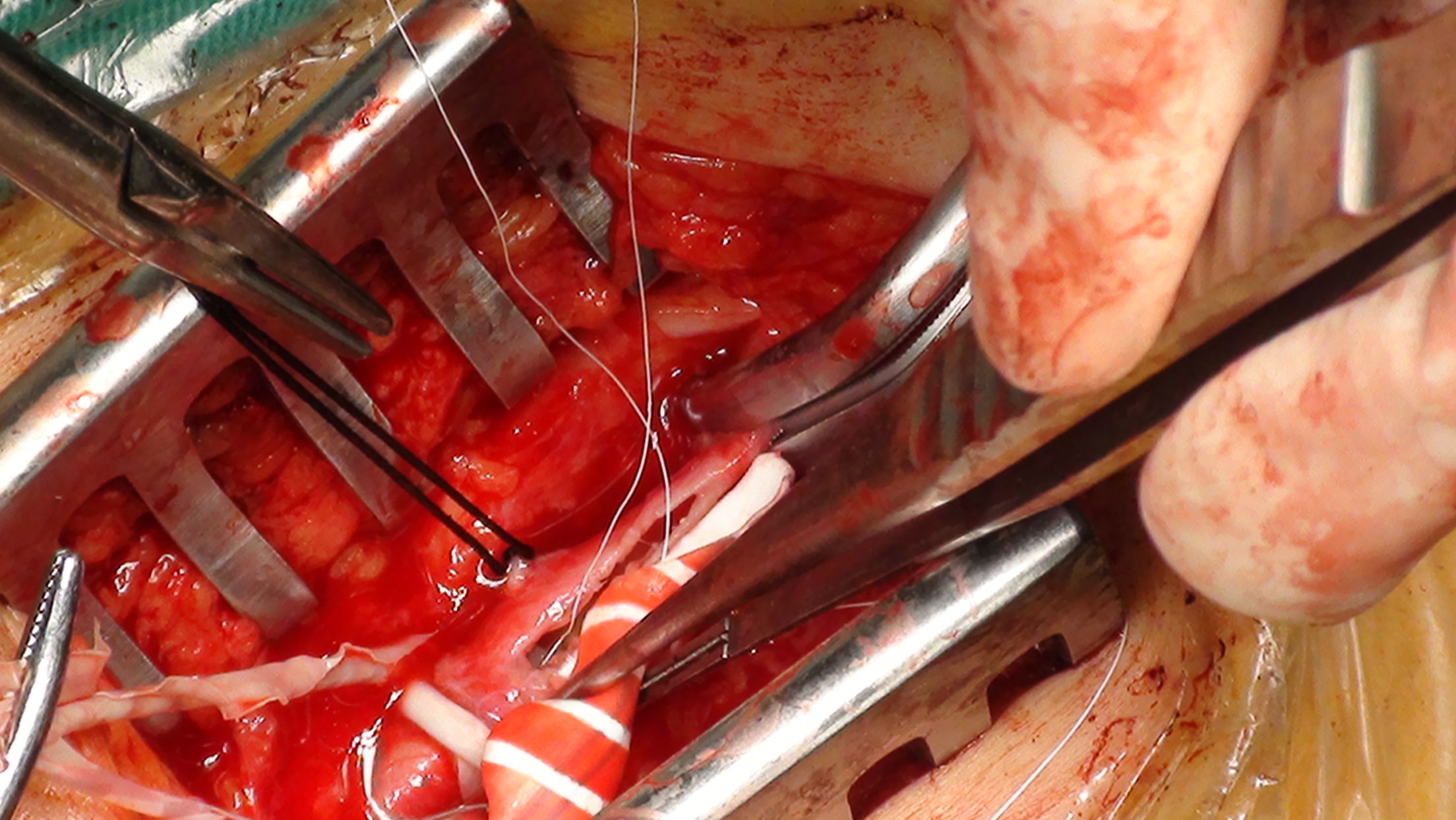 股动脉支架取出并股腘动脉人工血管转流手术治疗股动脉血管成形术后再