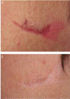 脚底黑痣癌变_黑痣会癌变吗_黑痣癌变图片