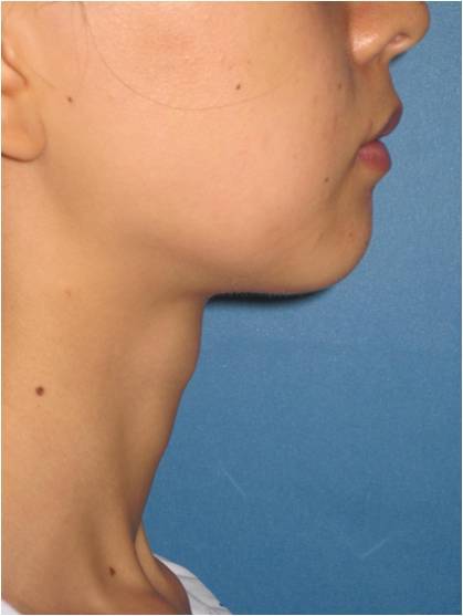 喉结肥大矫正手术 - 好大夫在线