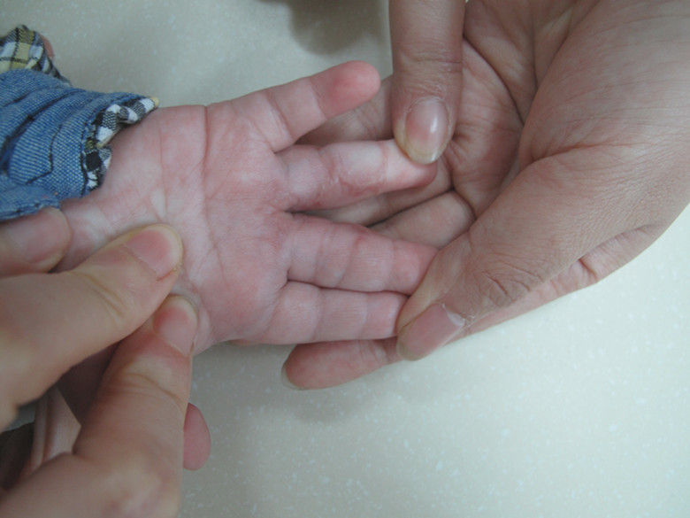 双翼皮瓣成形指蹼-——并指不植皮或减少植皮的新方法 - 好大夫在线