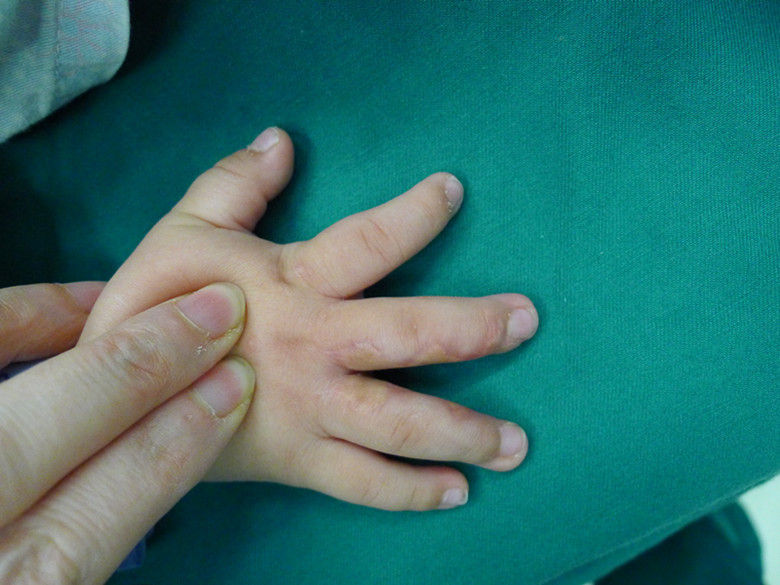 术后随访照片_先天性并指多指畸形_手术_治疗方式 - 好大夫在线