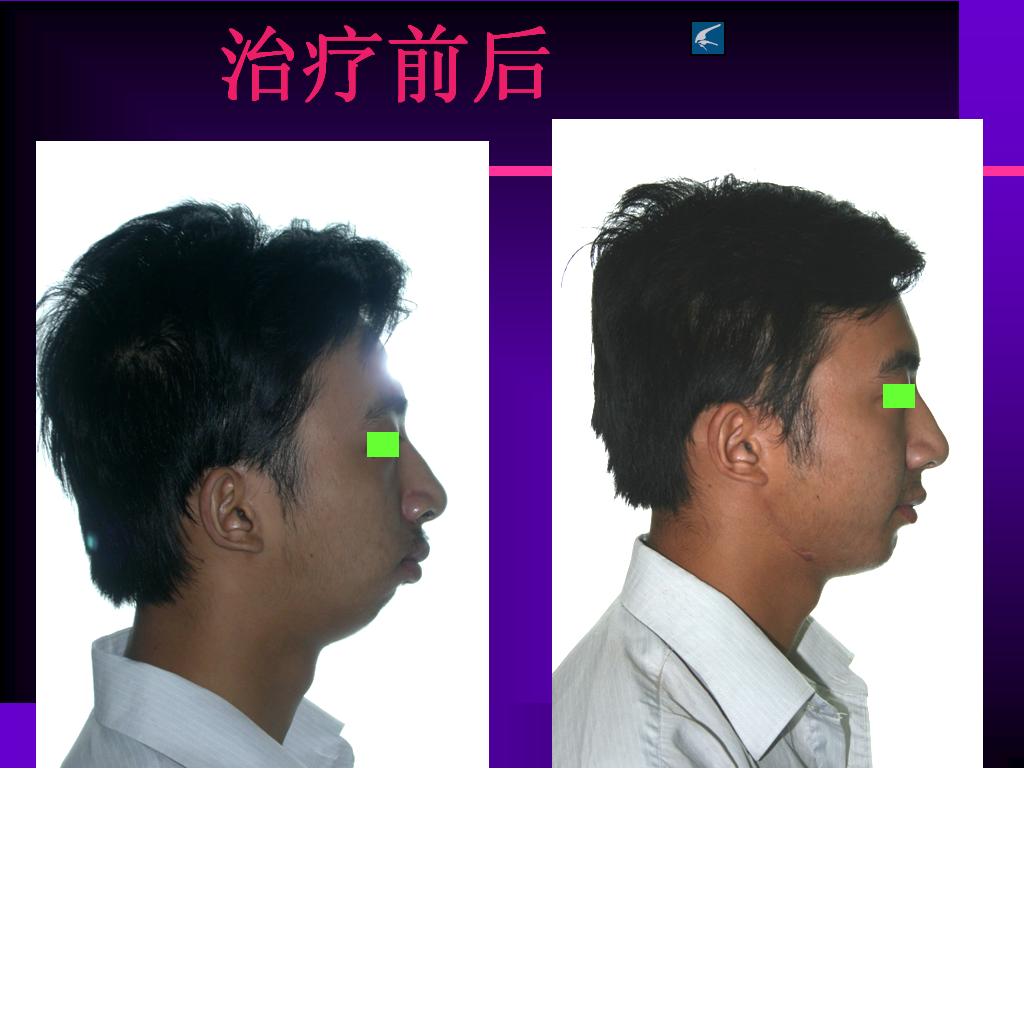 典型病例3关节强直颌骨畸形矫治 - 好大夫在线