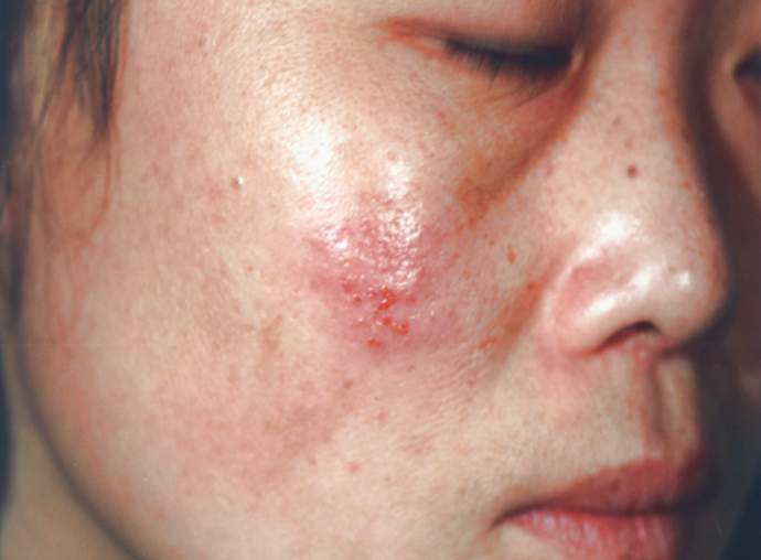 单纯疱疹 - 好大夫在线