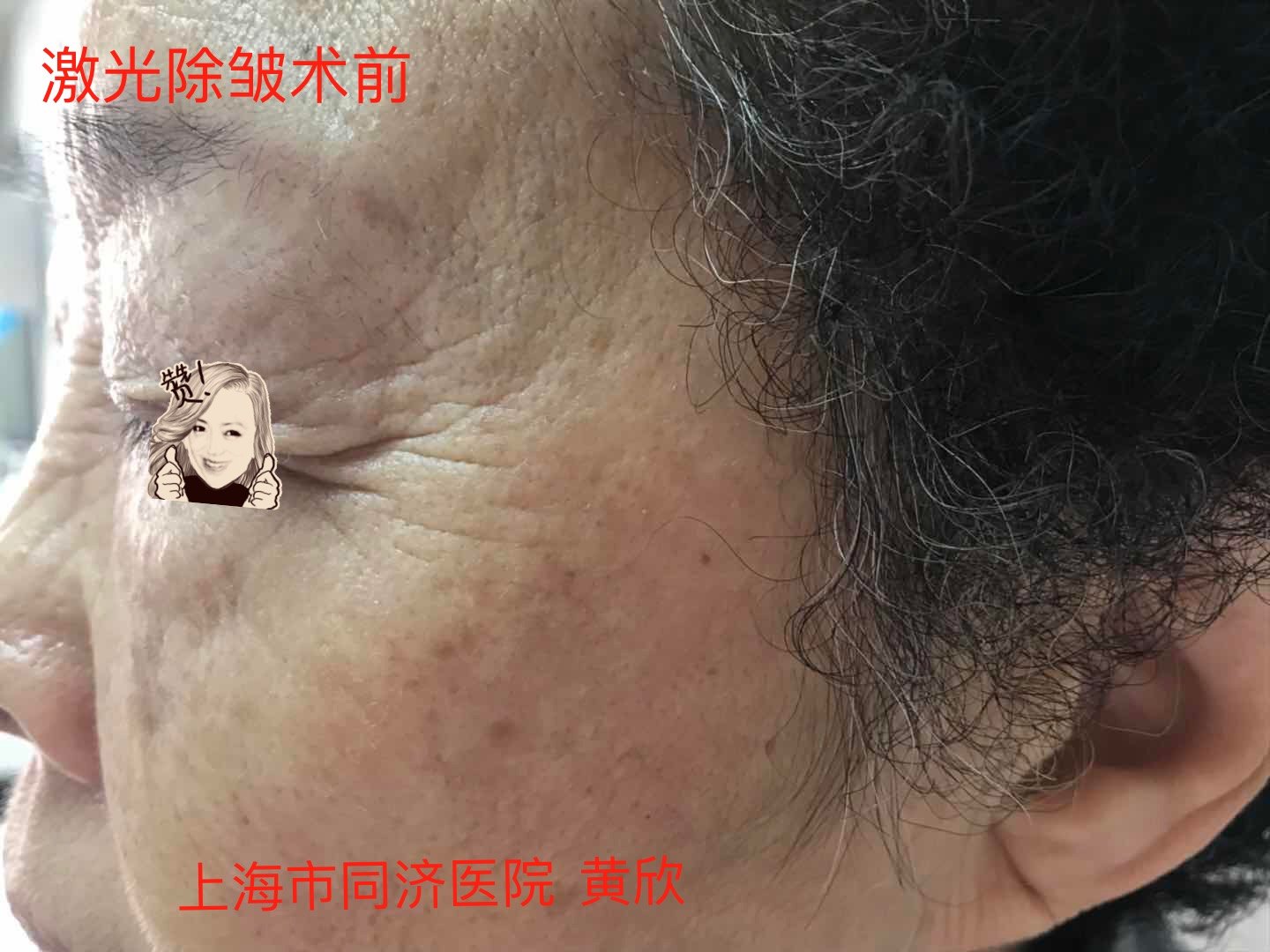 激光去皱图片