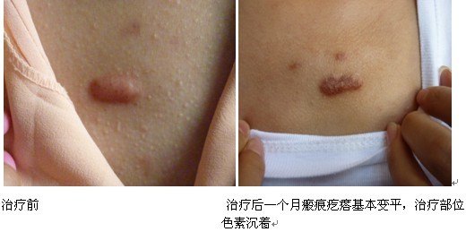 同位素敷贴治疗瘢痕疙瘩典型案例(山东青岛) - 好大夫在线