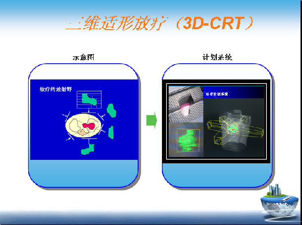三维适形 放疗 (3-dimensional conformal radiation therapy, 3d