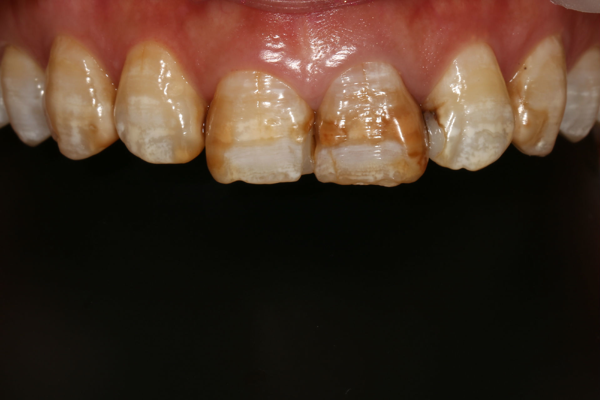 瓷贴面修复氟斑牙 一例 