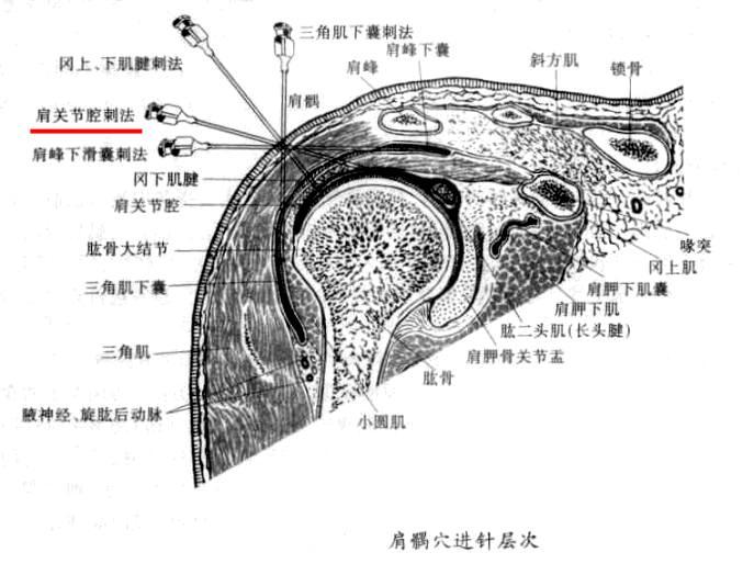 肩袖损伤的治疗(二) 