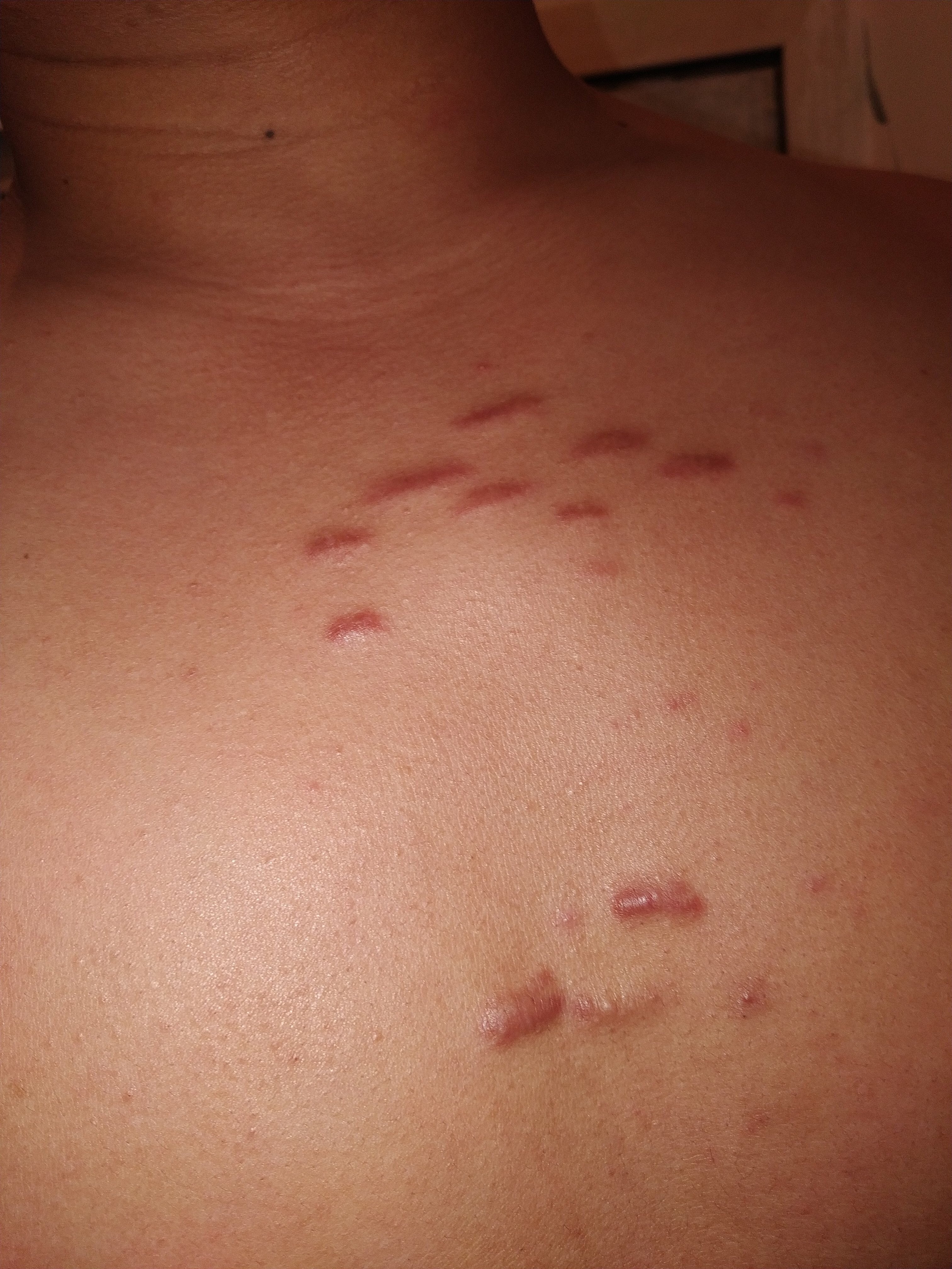俗称疤痕疙瘩,蟹足肿,巨痕症等2,什么原因引起?