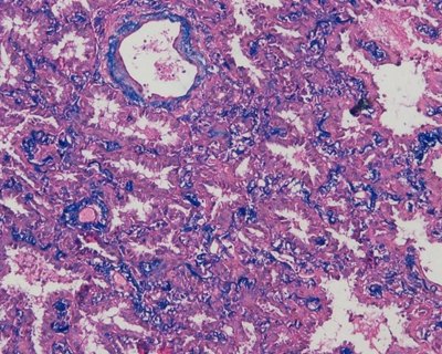 磨玻璃结节早期肺腺癌病理诊断中的问题与探讨 - 好大夫在线