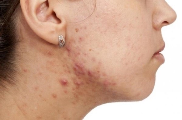 青春不再,痘还在(痤疮的病因和治疗)