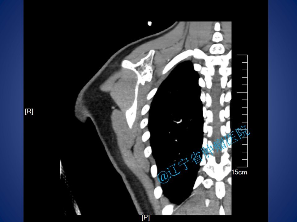 肩胛骨骨软骨瘤图片