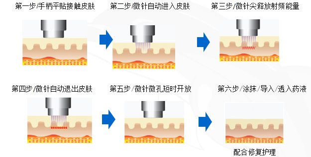 面部年轻化,妊娠纹.....黄金微针,你值得拥有! - 好大夫在线