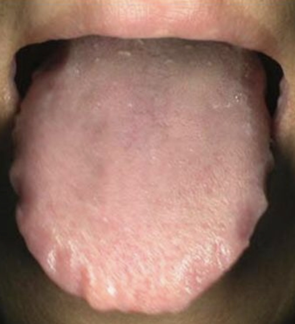 肝硬化舌苔图片图片