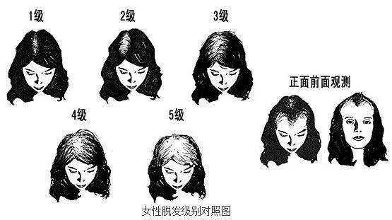 鬓角和额角分不清楚怎么办,科普两者区别告诉你!_脱发_症状_介绍 - 好大夫在线