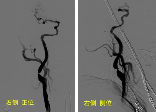 查dsa頭顱mri提示做出頂葉腦梗塞,dsa提示左側頸內動脈,大腦中動脈