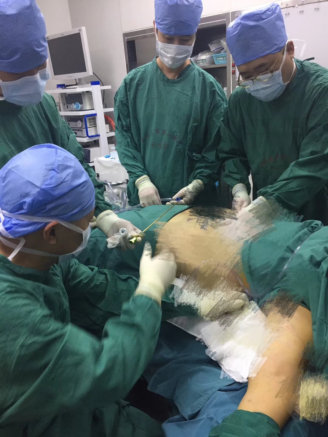 腹部,双上臂吸脂术 - 好大夫在线