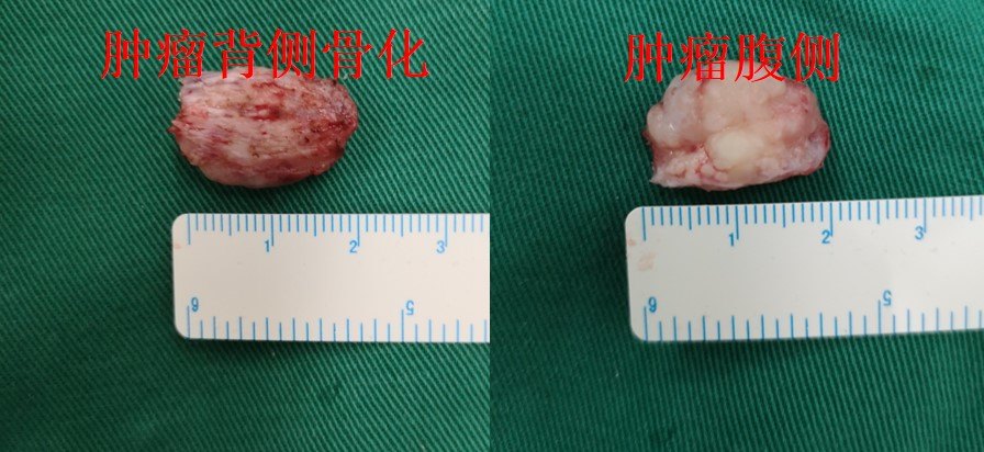 病例分享—胸椎管骨化脊膜瘤完整切除1例 - 好大夫在线