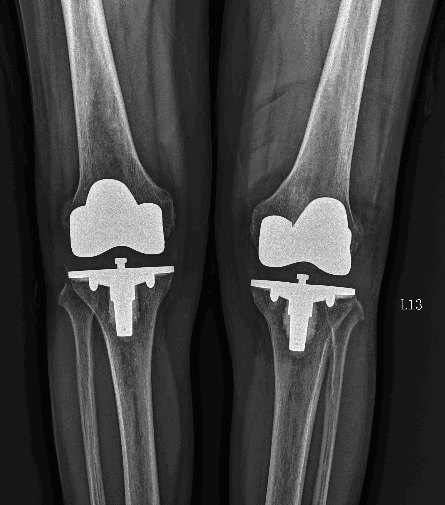 人工膝关节置换手术 - 好大夫在线
