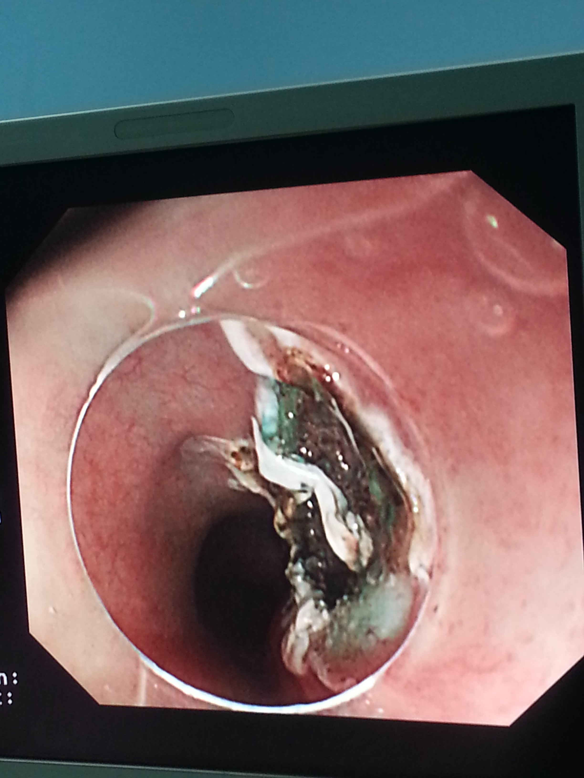 食管平滑肌瘤esd术