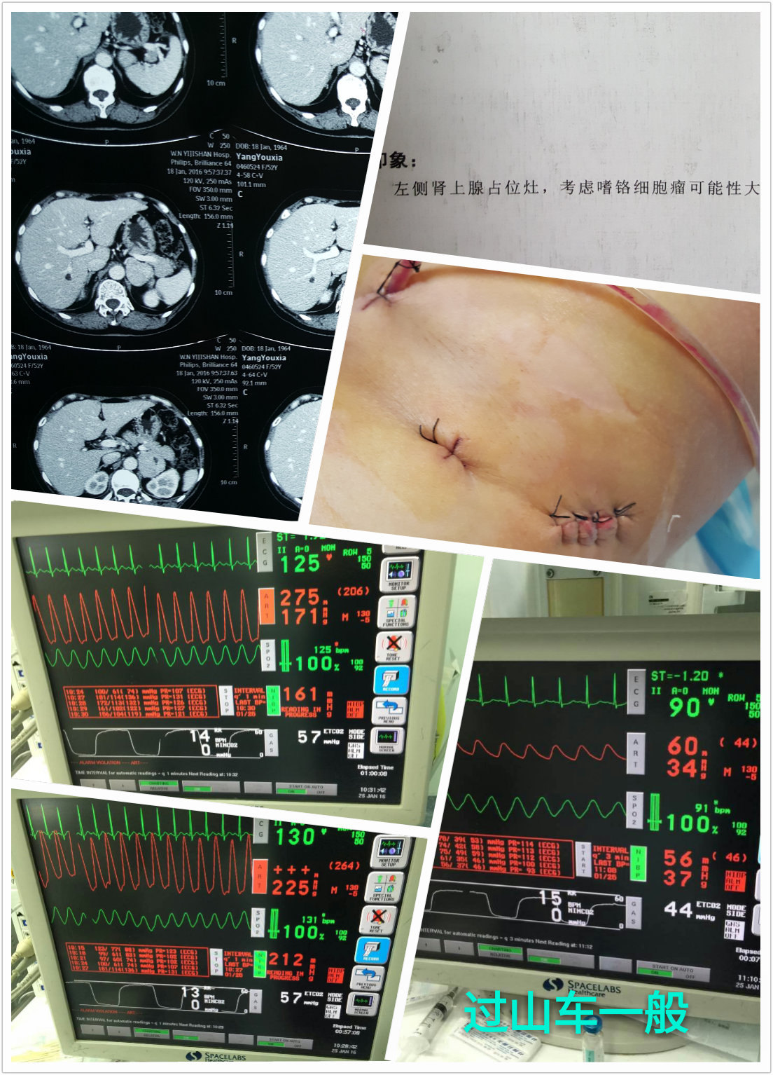 肾上腺嗜铬细胞瘤腹腔镜手术
