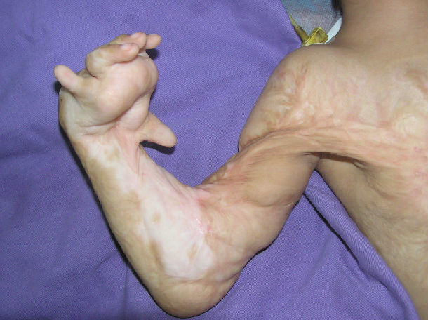 上肢瘢痕挛缩畸形 - 好大夫在线