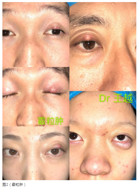 霰粒肿如何治疗 霰粒肿 治疗方法