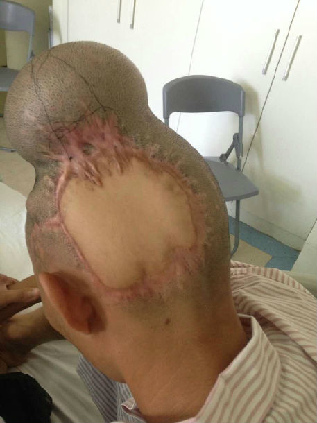 头皮缺失到毛发再生过程:图示一例 - 好大夫在线