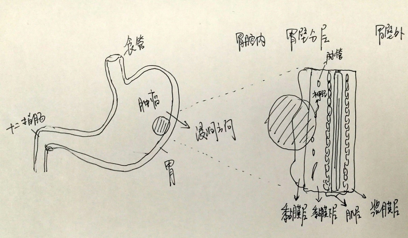 胃癌术后病理报告单到底说了些啥?