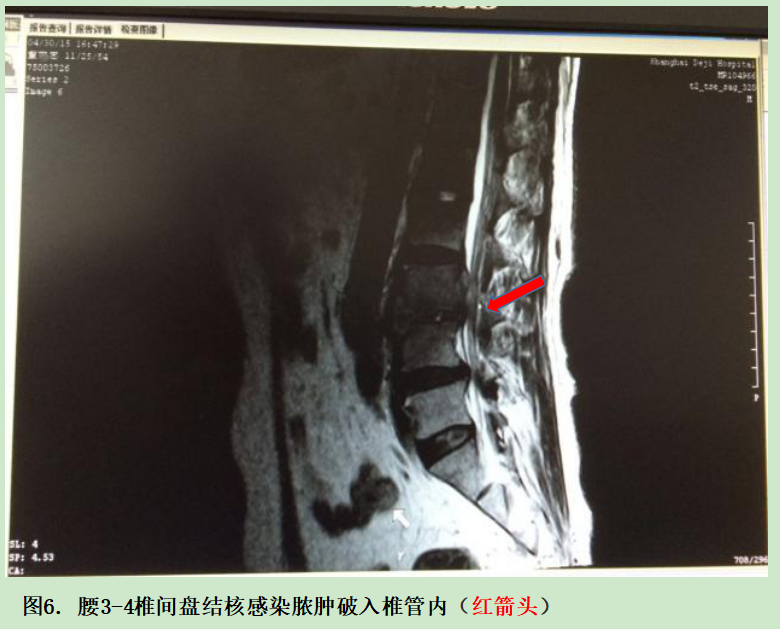 腰椎结核 !--haodf:8:ganran-->感染 !--haodf:/8:ganran-->.png