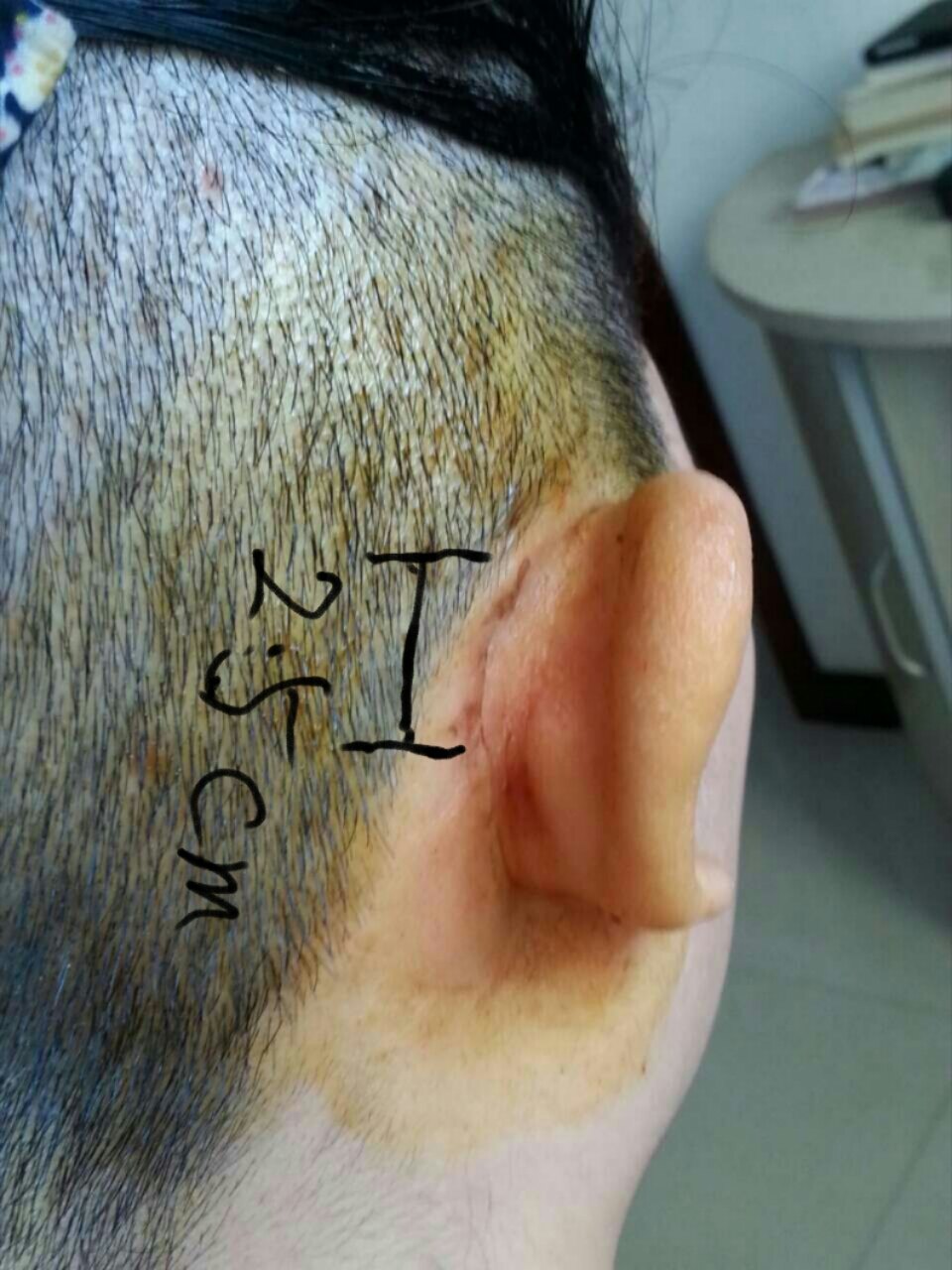 人工耳蜗