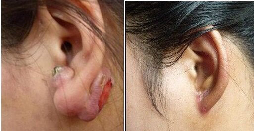 瘢痕松解局部改形术:对具有张力的较小的条索状,蹼状瘢痕可将瘢痕切除