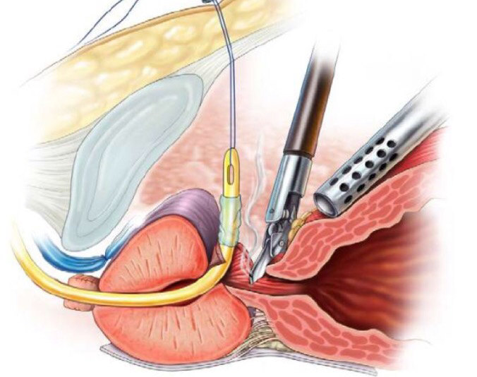 前列腺癌你有这些误区吗