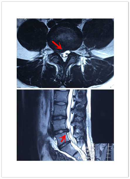 典型病例:椎间孔镜微创治疗腰间盘突出