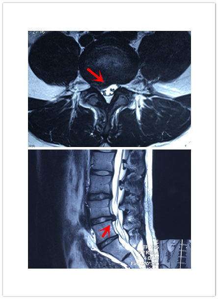 l4-5椎间盘突出图片