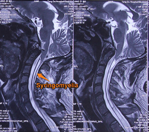 典型病例精细手术修复chiari畸形伴脊髓空洞症