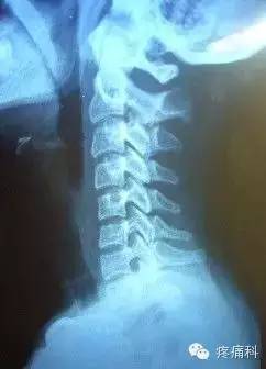 颈椎X线拍片报告上的颈椎生理曲度变直是什