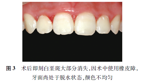 正畸结束后牙齿表面形成的白垩斑怎么办