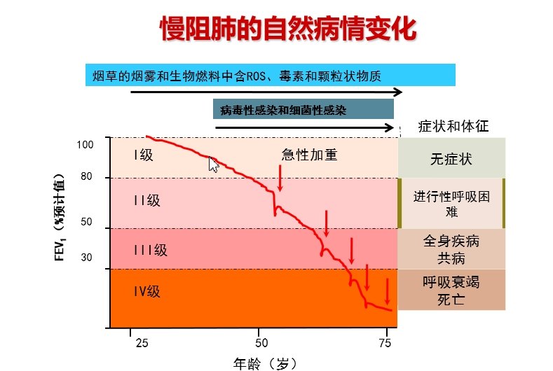 <!--HAODF:8:manzhufei-->慢阻肺<!--HAODF:/8:manzhufei-->的自然病情变化.jpg