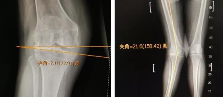 股骨远端闭合截骨(dfo)治疗严重膝外翻畸形 - 好大夫在线