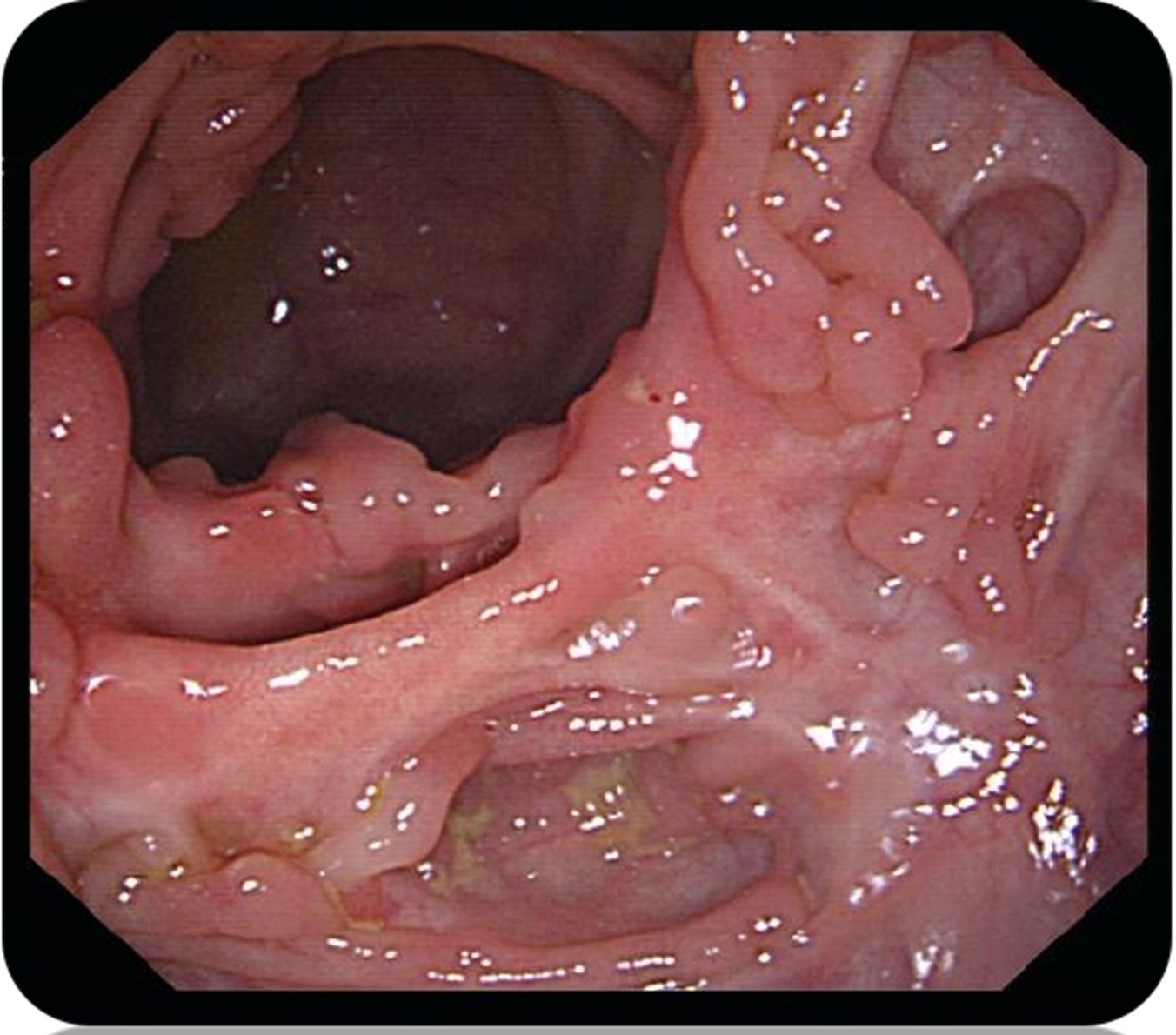 肠梗阻腹部膨隆图片图片