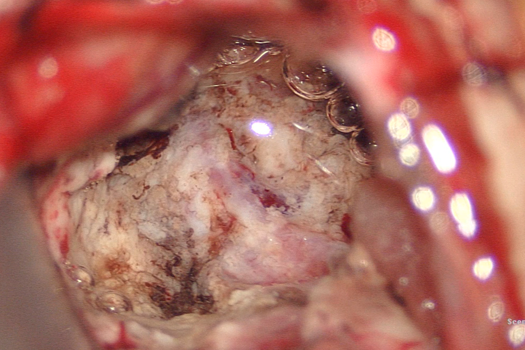 白內障;2.左肺下葉惡性腫瘤;1.左側額葉轉移瘤;61初步診斷:2.