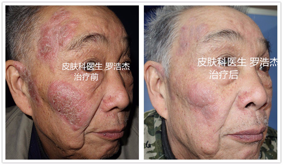 雨荨是公主烁荨文_荨麻疹的11个过敏源图片_假麻疹和麻疹的区别