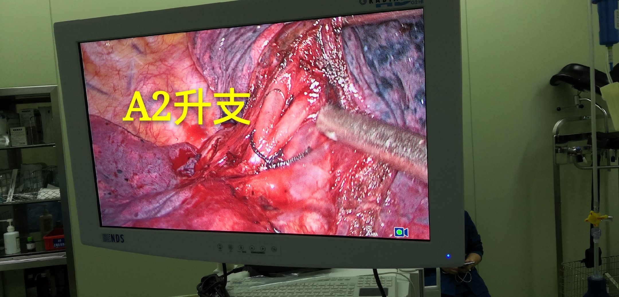 哈医大二院胸外科经典病例之胸腔镜下右肺s2切除术 - 好大夫在线